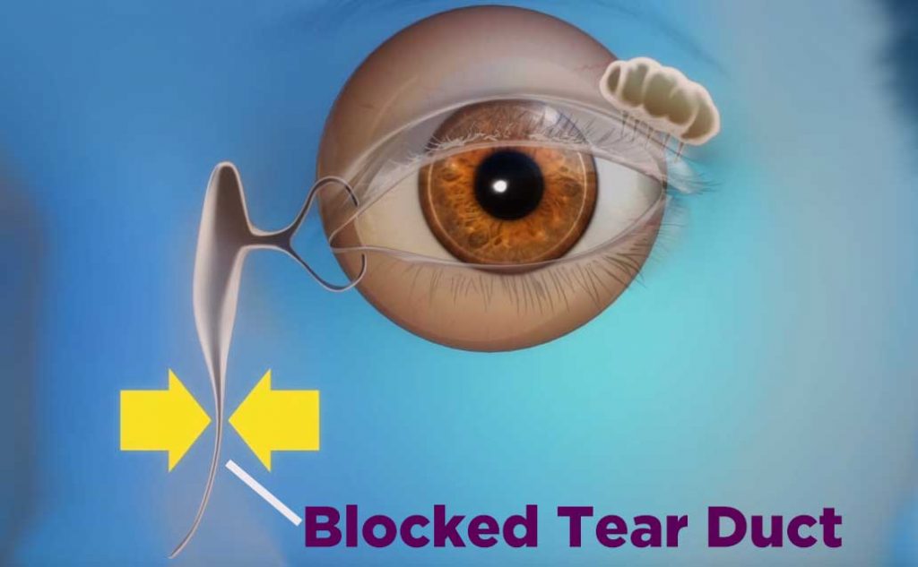 Sticky Eyes In New Born Babies Symptoms, Reason and Treatment